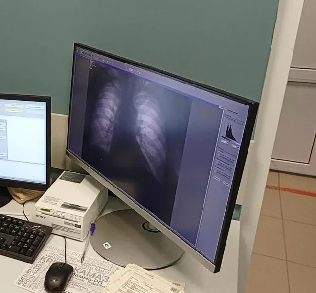 Цифровые флюорографы поступили в&nbsp;медучреждения Тульской области
